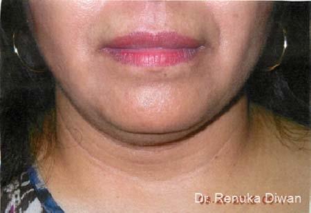 Liposuction: Patient 1 - Before 