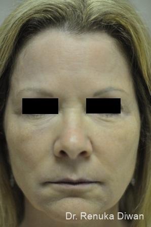 Non-Surgical Facelift: Patient 2 - Before 