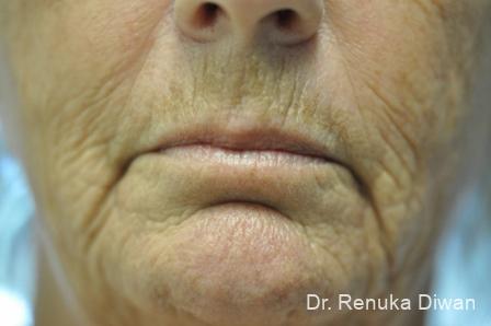 Laser Skin Resurfacing: Patient 6 - Before and After 2