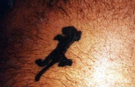 Tattoo Removal: Patient 3 - Before 
