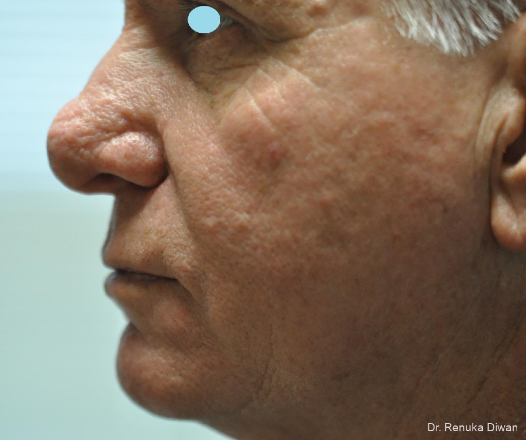 Lasers For Rhinophyma: Patient 5 - Before 4