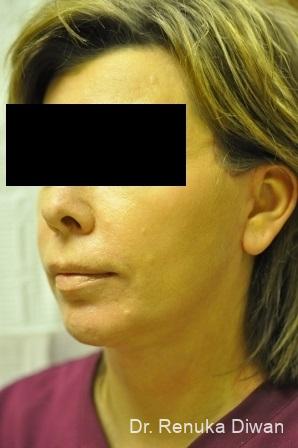 Chin Augmentation: Patient 1 - After  