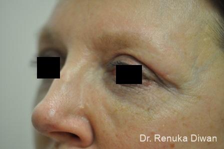 Blepharoplasty: Patient 8 - After 2