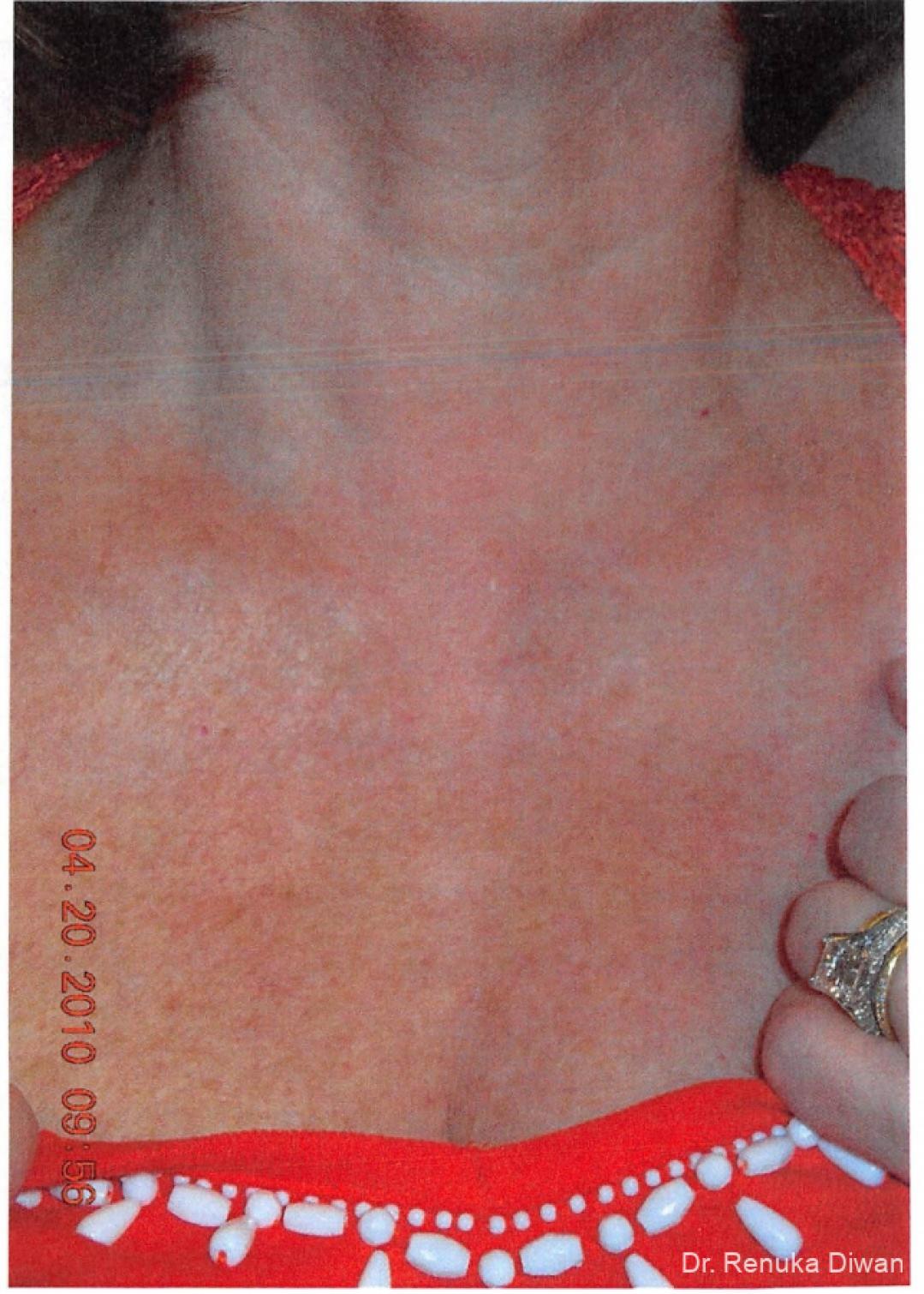 Lasers For Brown Spots: Patient 2 - After 1