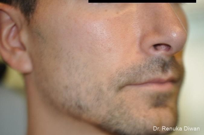 Jawline Augmentation: Patient 1 - Before and After 3