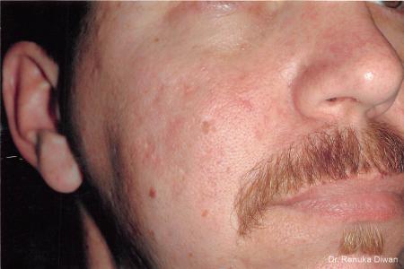Acne Scars: Patient 1 - After  