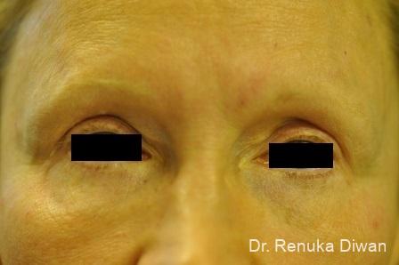 Blepharoplasty: Patient 7 - After  