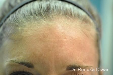 Forehead Creases: Patient 5 - After 1
