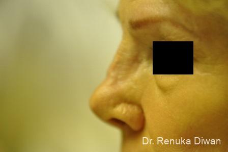 Non-Surgical Rhinoplasty: Patient 1 - Before 2