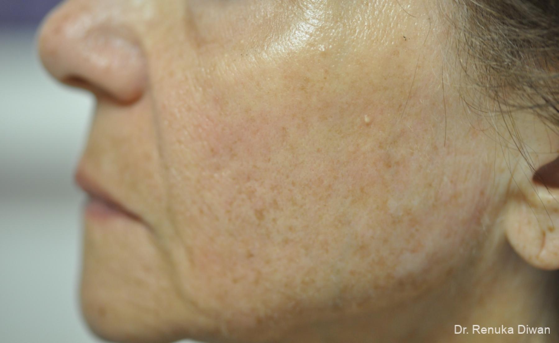 Lasers For Brown Spots: Patient 15 - After 2