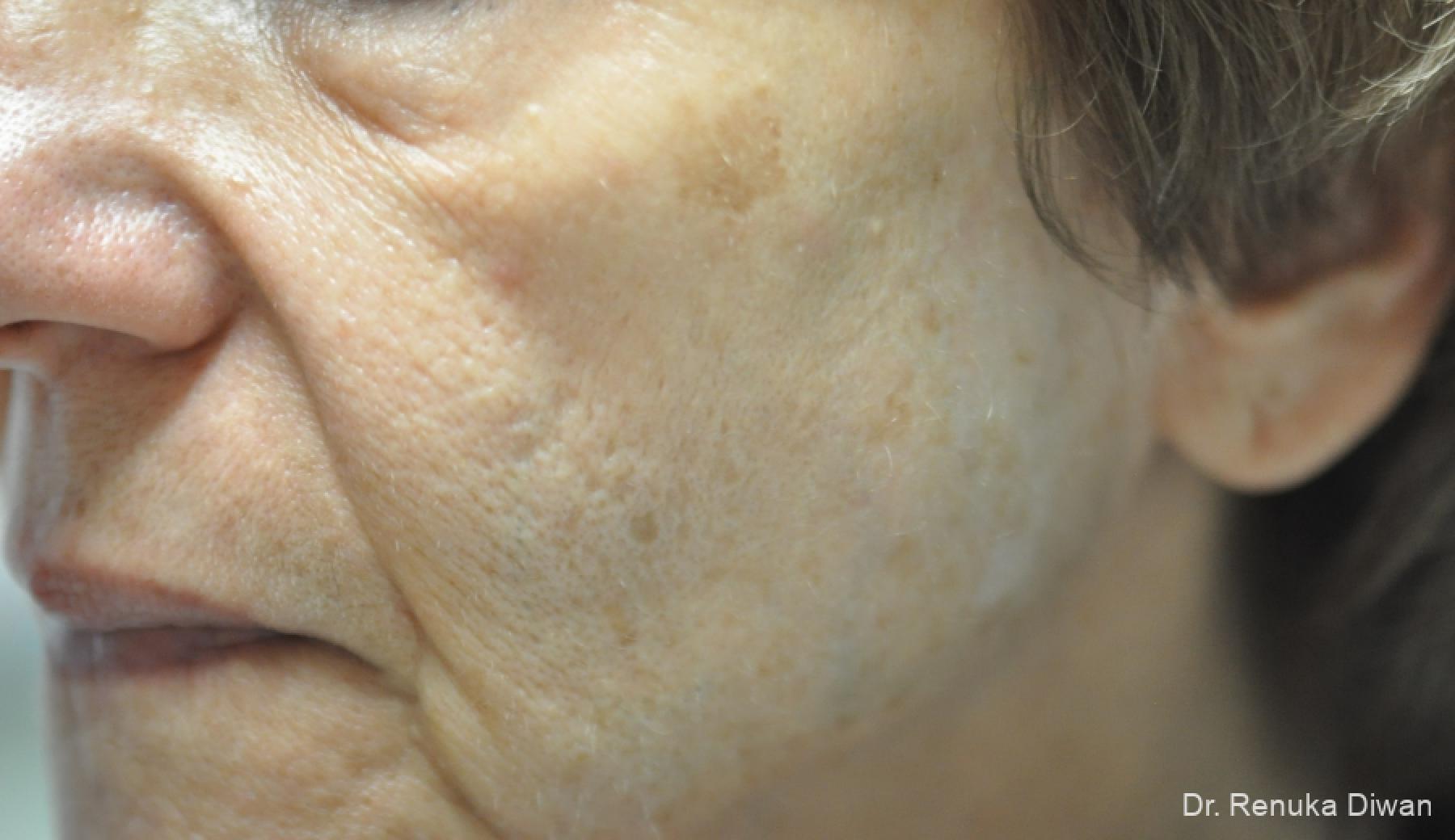 Lasers For Brown Spots: Patient 15 - Before and After 2