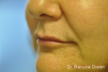Lips And Mouth: Patient 17 - After 2