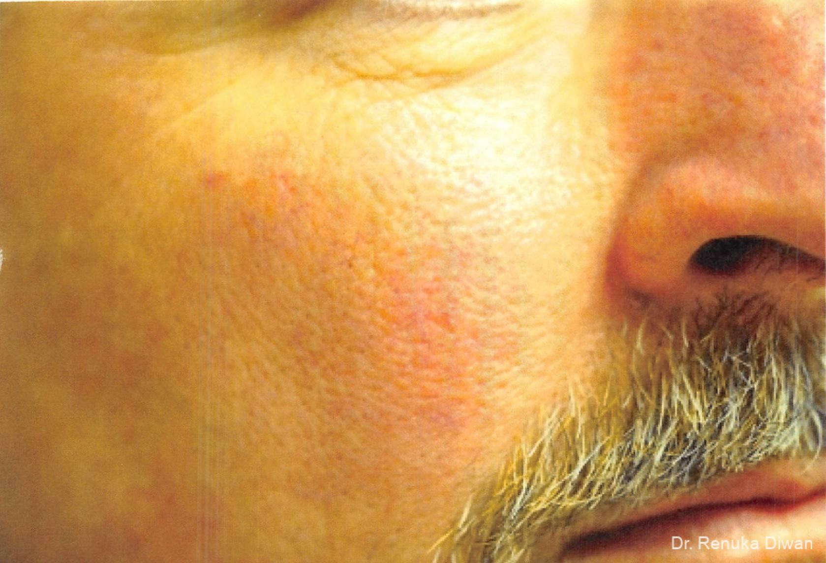 Laser For Veins And Redness For Men: Patient 6 - After 1
