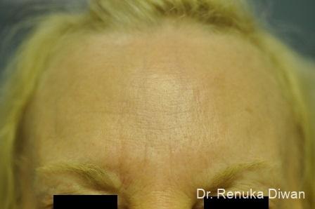 Forehead Creases: Patient 4 - After 1