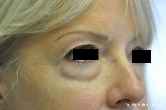 Blepharoplasty: Patient 9 - Before 