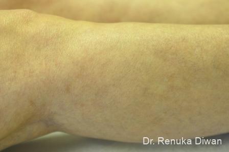 Veins On Legs: Patient 4 - After 2