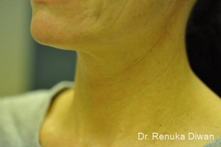 Neck Creases: Patient 3 - Before 