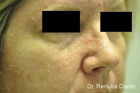 Laser For Veins And Redness: Patient 16 - After 1