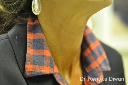 Neck Creases: Patient 2 - After 1