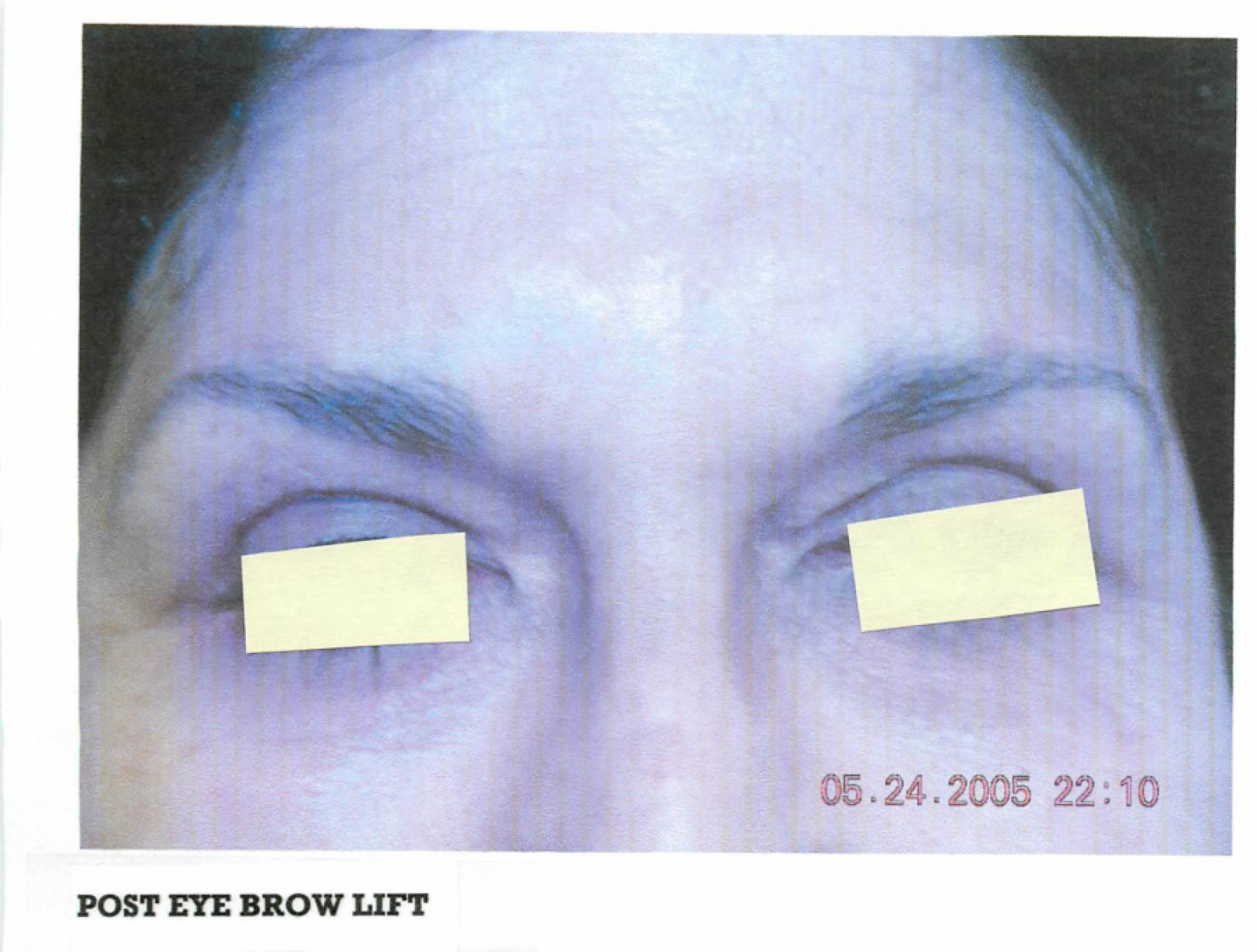 Brow Lift: Patient 1 - After  