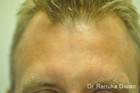 Botox Cosmetic For Men: Patient 2 - After 1