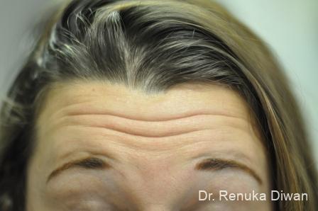 Forehead Creases: Patient 7 - Before 1