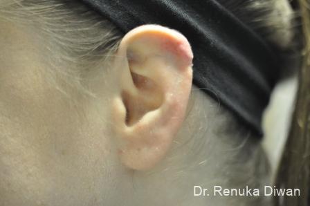 Earlobe Surgery: Patient 7 - After 1