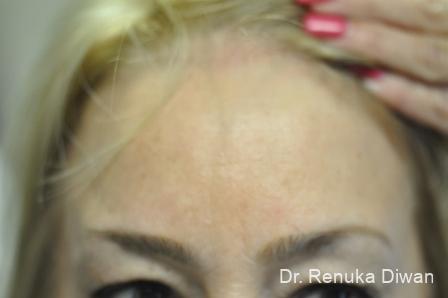 BOTOX® Cosmetic: Patient 7 - After  