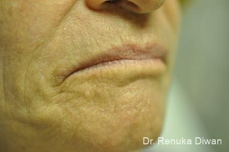 Laser Skin Resurfacing: Patient 9 - After  