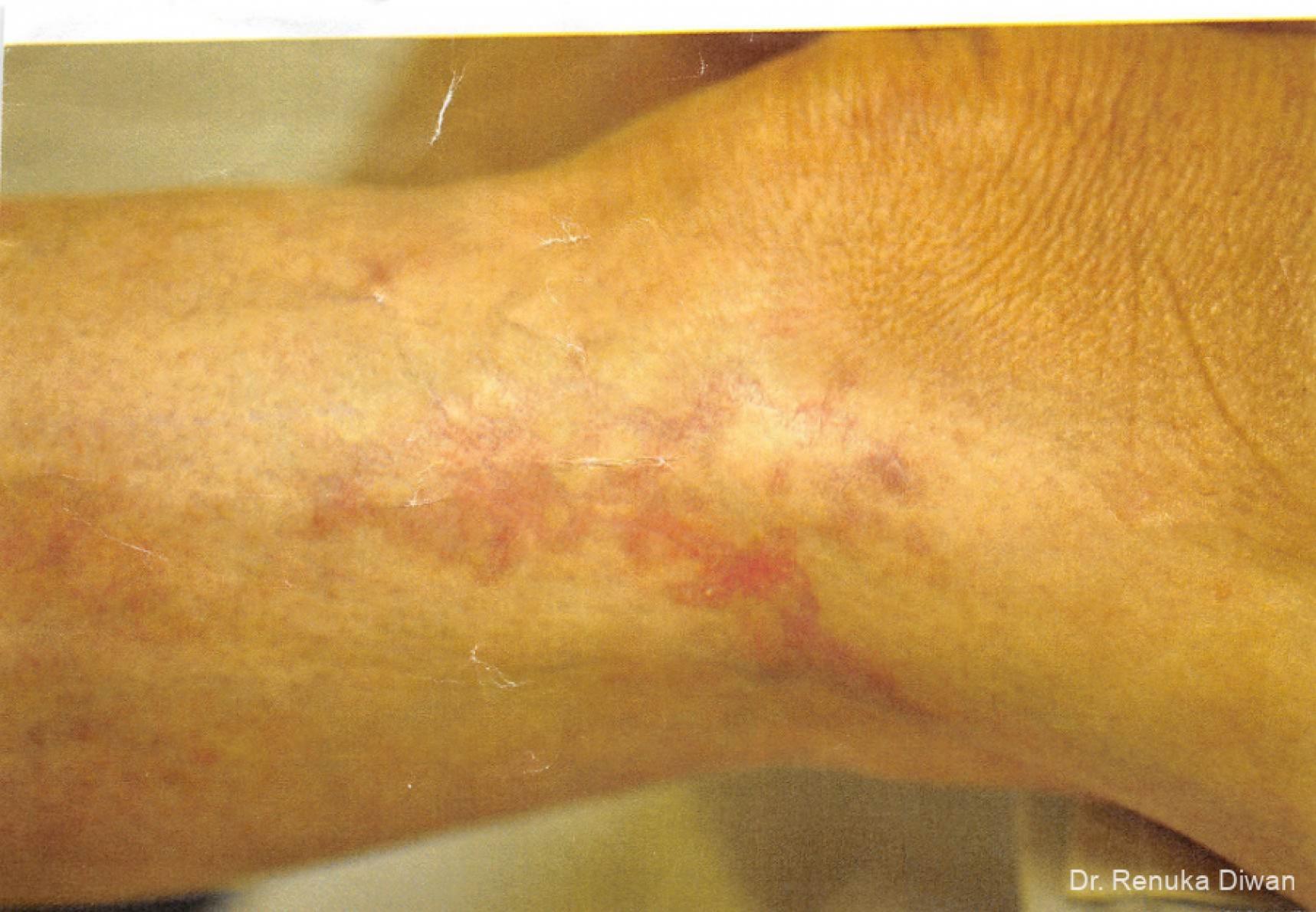 Scar Revision: Patient 1 - Before 