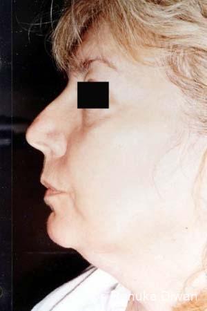 Liposuction: Patient 3 - Before 