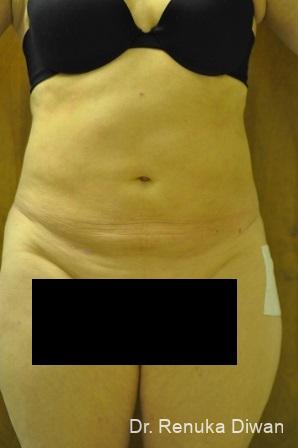 Liposuction: Patient 12 - After 1