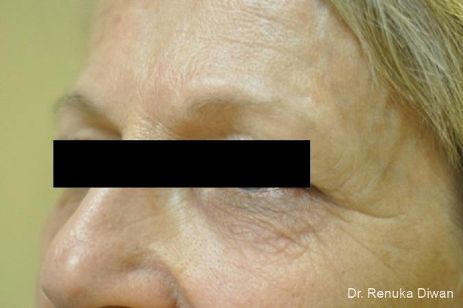 Microneedling: Patient 1 - After 1