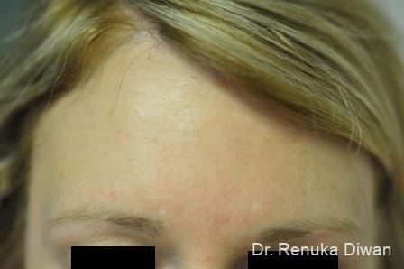 BOTOX® Cosmetic: Patient 12 - After Image