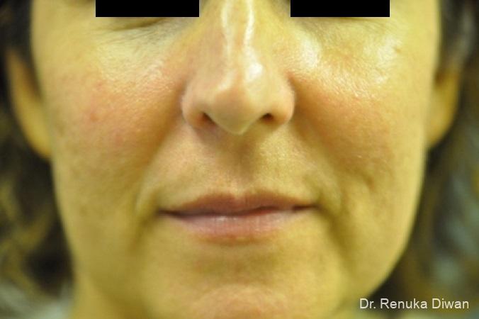 Laser For Veins And Redness: Patient 8 - After 1