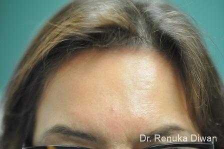 Forehead Creases: Patient 8 - After  