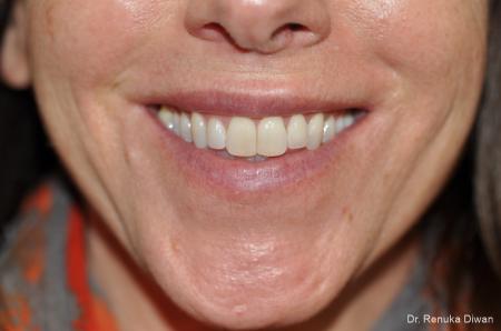 Gummy Smile: Patient 1 - After Image