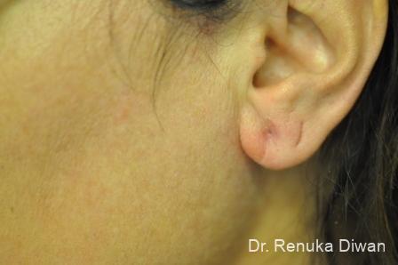 Earlobe Surgery: Patient 4 - After 1
