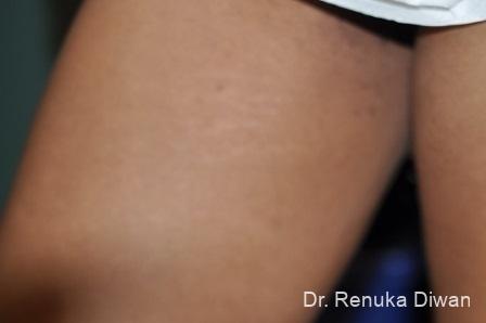 Stretch Marks: Patient 1 - Before 1
