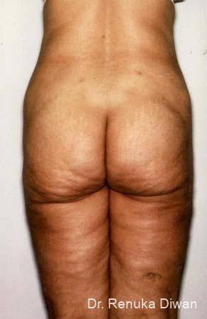 Liposuction: Patient 10 - After 1