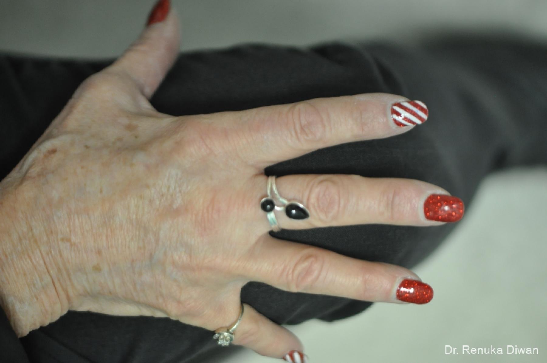 Hand Augmentation: Patient 1 - After 2