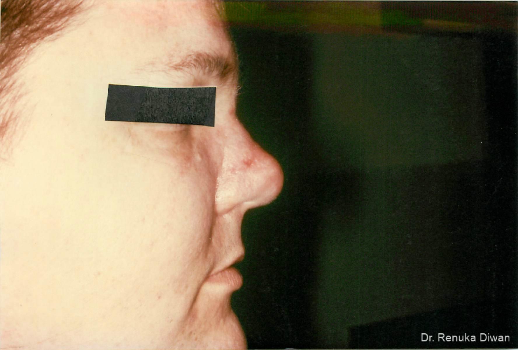 Lasers For Rhinophyma: Patient 3 - After 1