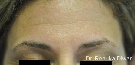 BOTOX® Cosmetic: Patient 19 - Before and After 2