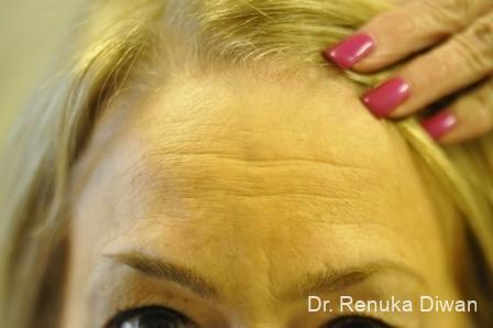 BOTOX® Cosmetic: Patient 7 - Before 1