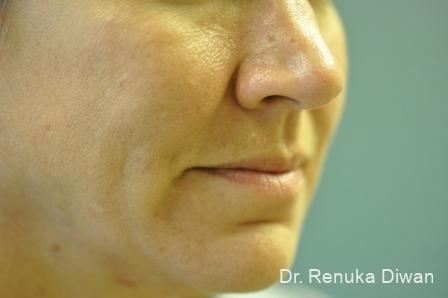 Loss Of Fullness: Patient 3 - After 1