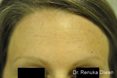 Forehead Creases: Patient 1 - After  