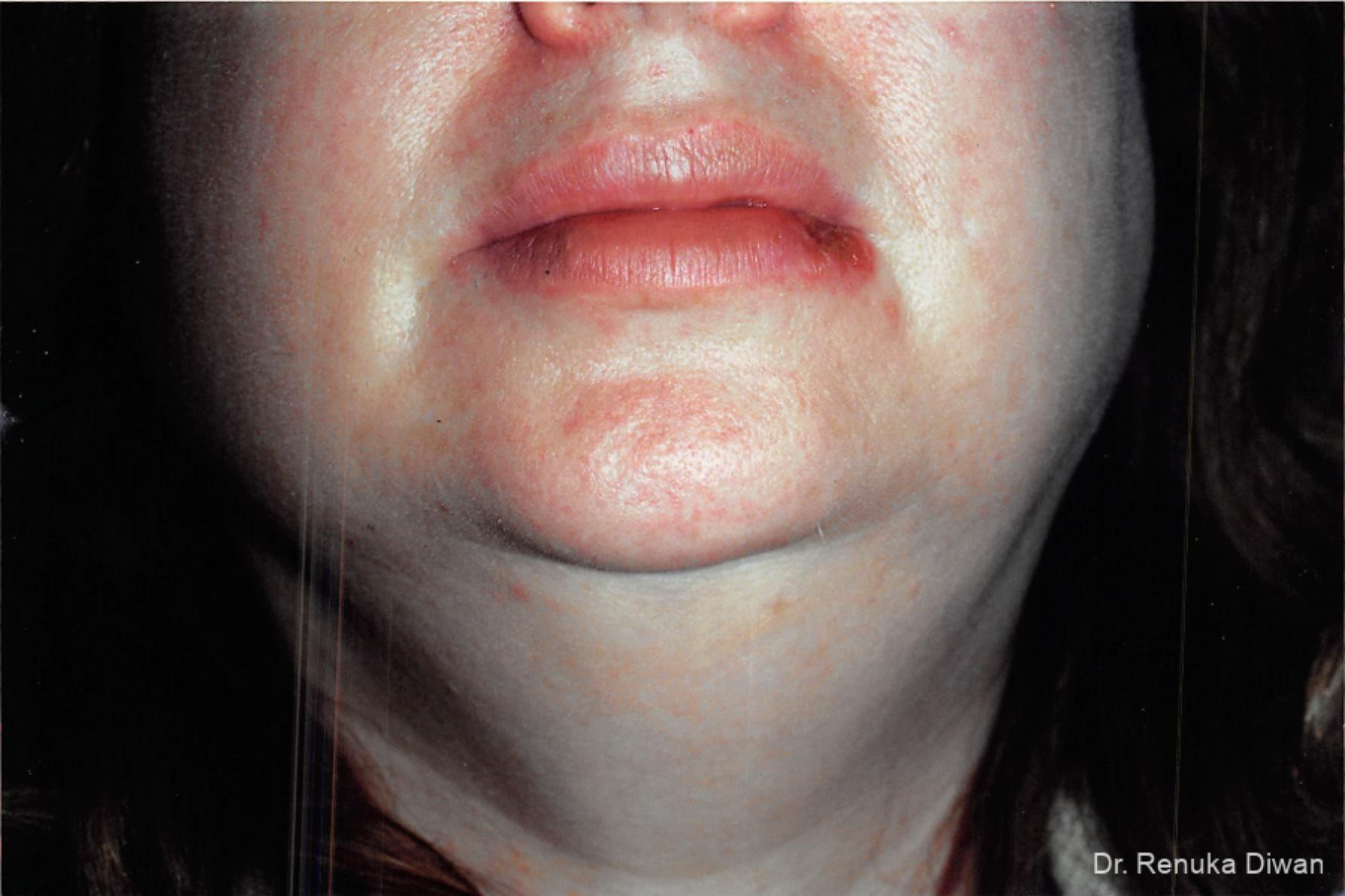 Laser For Veins And Redness: Patient 17 - After 1