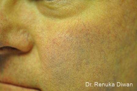 Laser-for-veins-and-redness-for-men: Patient 2 - Before 