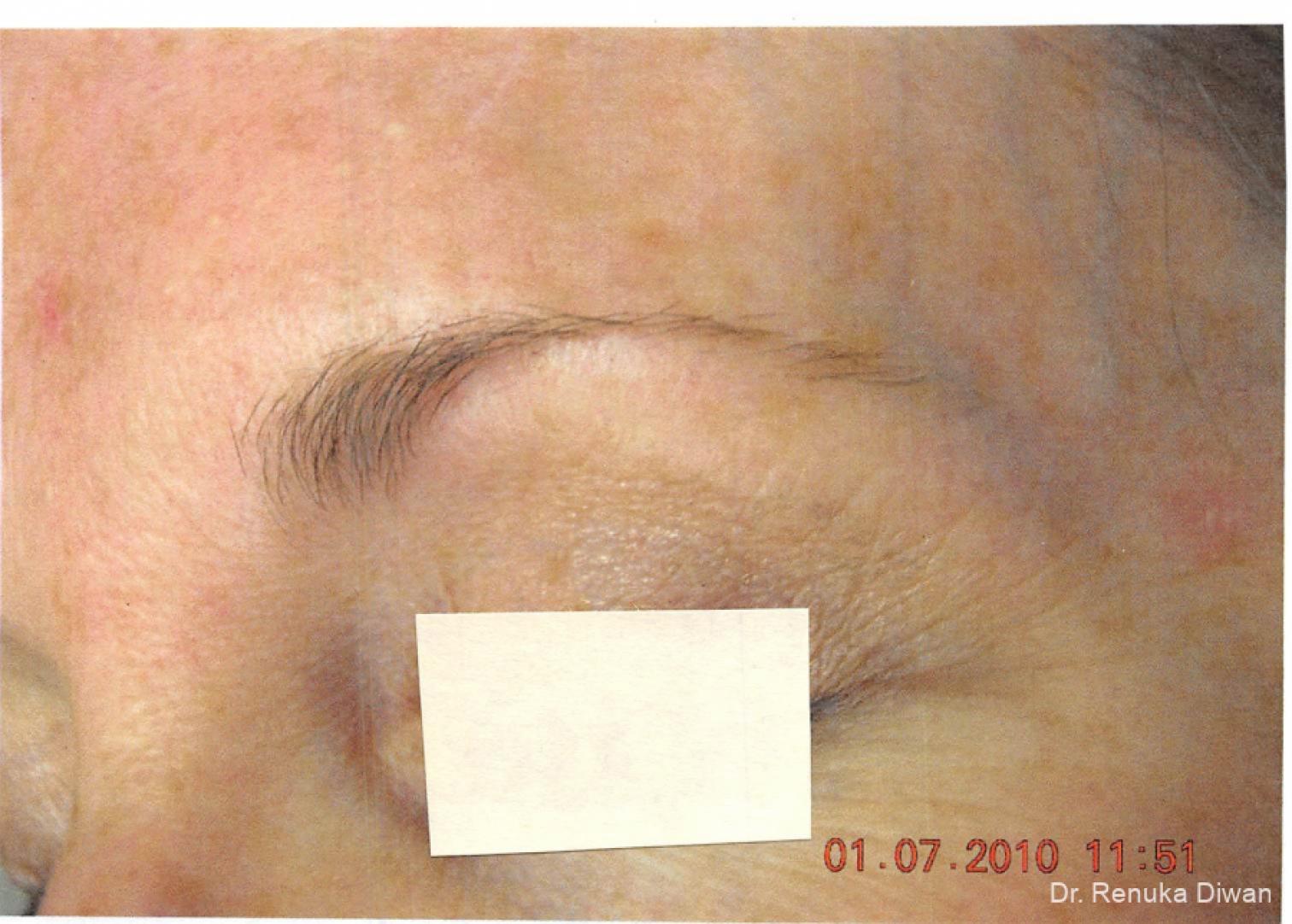 Laser For Veins And Redness: Patient 3 - After 1
