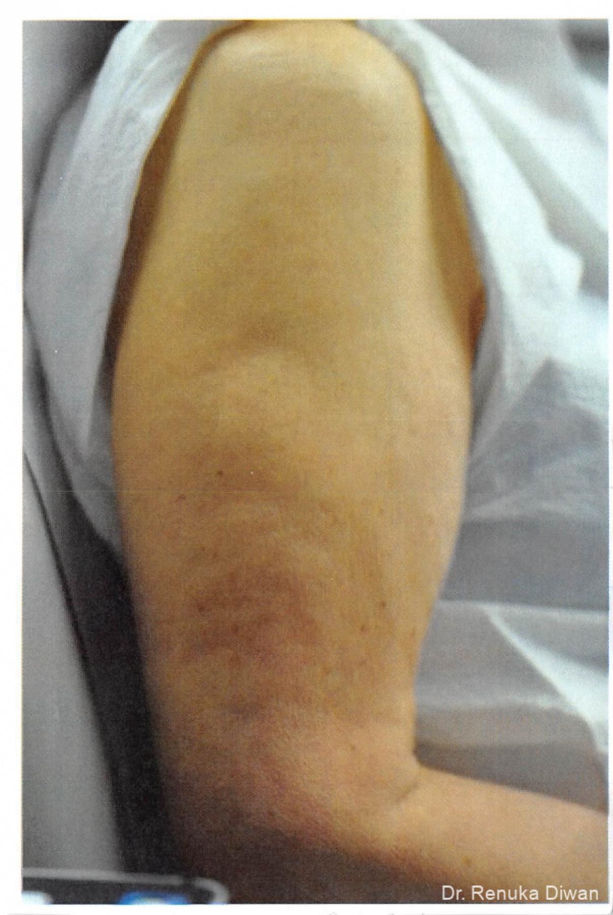 Skin Tightening: Patient 7 - After  